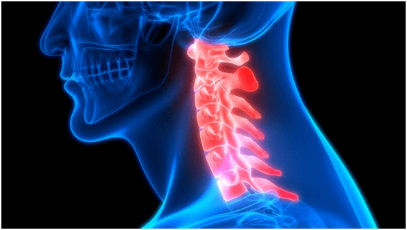 il dolore al collo porta al mal di schiena