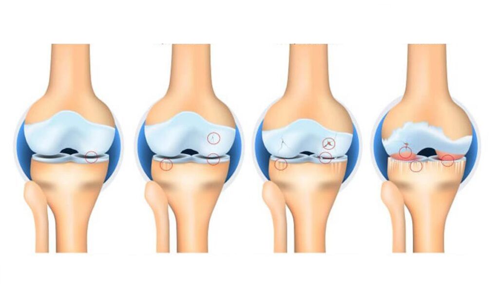 fasi dell'artrosi dell'articolazione del ginocchio