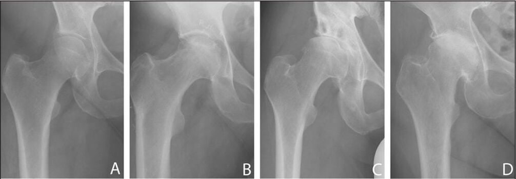 Fasi di sviluppo dell'artrosi dell'articolazione dell'anca su una radiografia