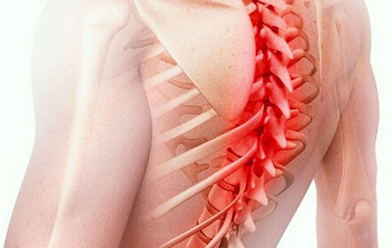 osteocondrosi della colonna vertebrale toracica