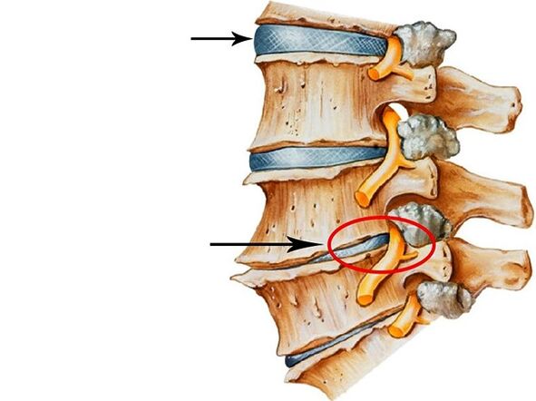 Disturbi nei dischi intervertebrali
