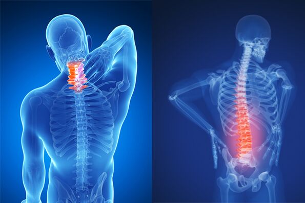 Osteocondrosi del rachide cervicale e lombare