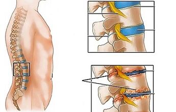 Le cause dell'osteocondosi del lombare