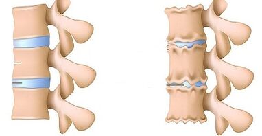 come riconoscere la presenza di osteocondosi del lombare