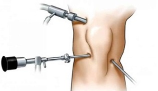 artroscopia per l'artrosi dell'articolazione del ginocchio