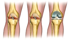 endoprotesi per l'artrosi dell'articolazione del ginocchio