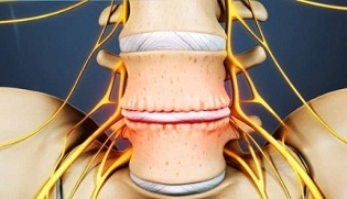 i principali sintomi dell'osteocondrosi cervicale